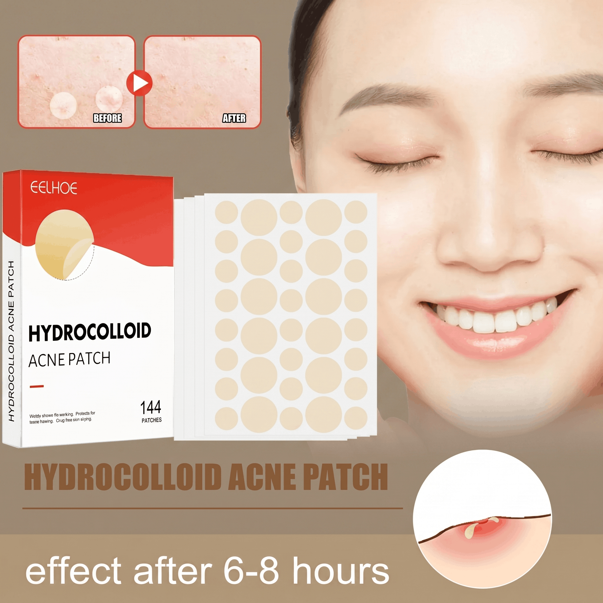 Translucent Hydrocolloid Acne Patches