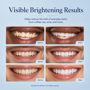 AuraGlow Teeth Whitening Kit
