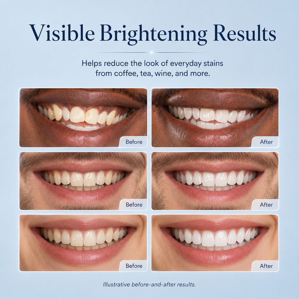 AuraGlow Teeth Whitening Kit