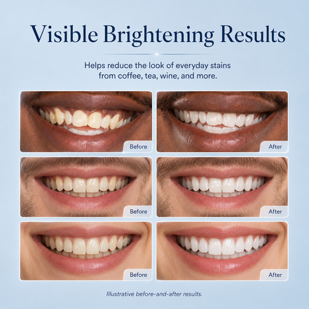 AuraGlow Teeth Whitening Kit